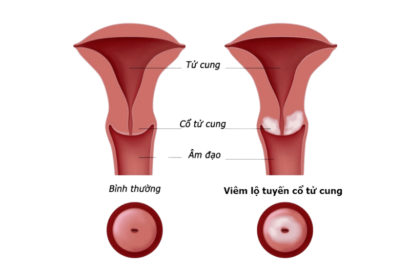 Áp lạnh cổ tử cung được chỉ định trong điều trị viêm lộ tuyến cổ tử cung