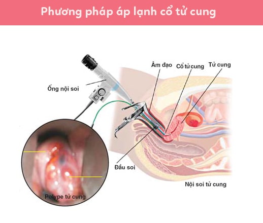 Máy áp lạnh cổ tử cung là gì? Vì sao phương pháp áp lạnh được ưa chuộng?